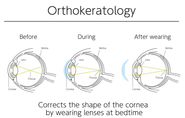 Orthokeratology involves reshaping or molding the cornea’s surface using unique contact lenses rather than undergoing extensive surgical procedure.