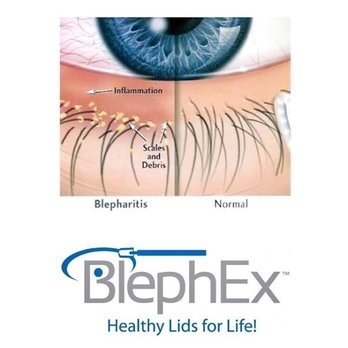eye diagram for belpharitis