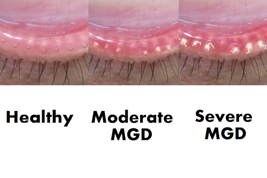 eye lid diagram